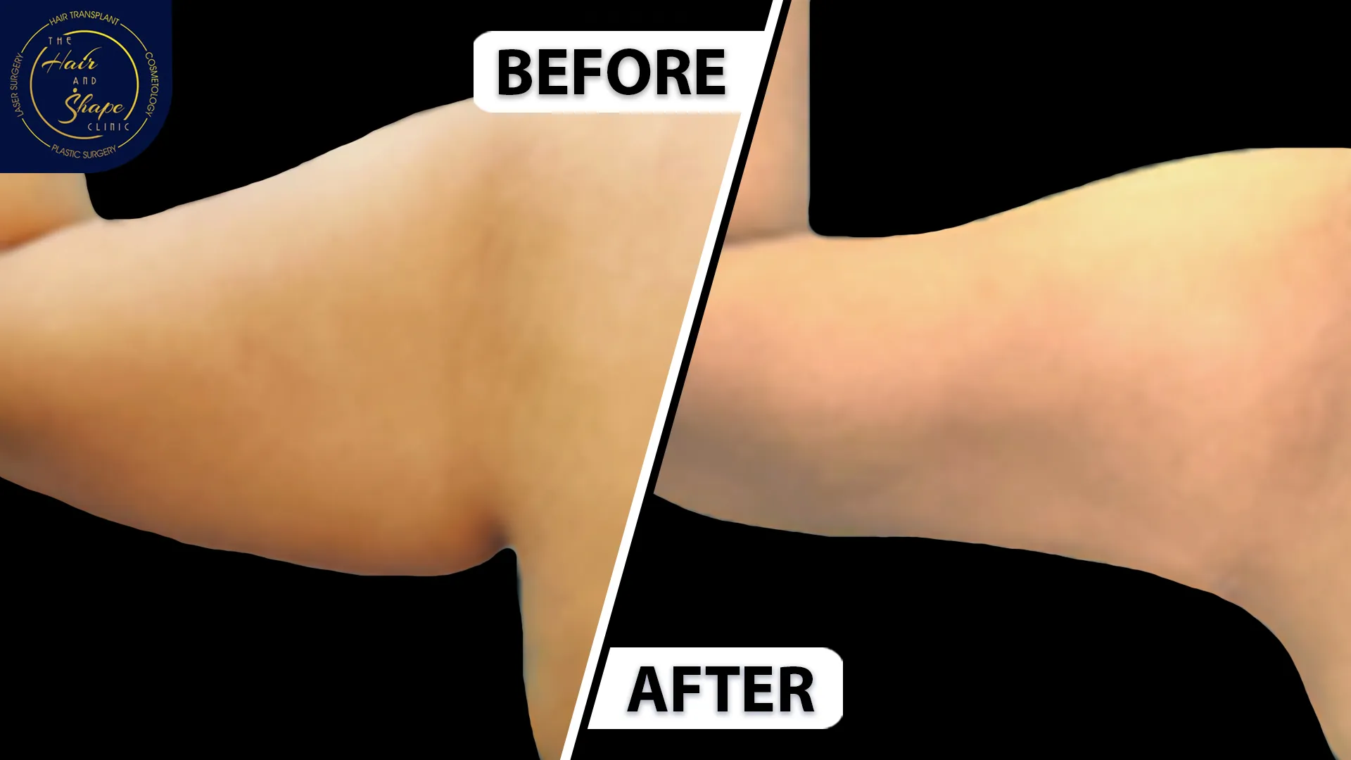 Arm lift result4